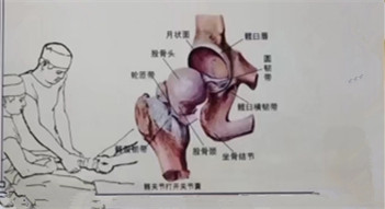 股骨头坏死