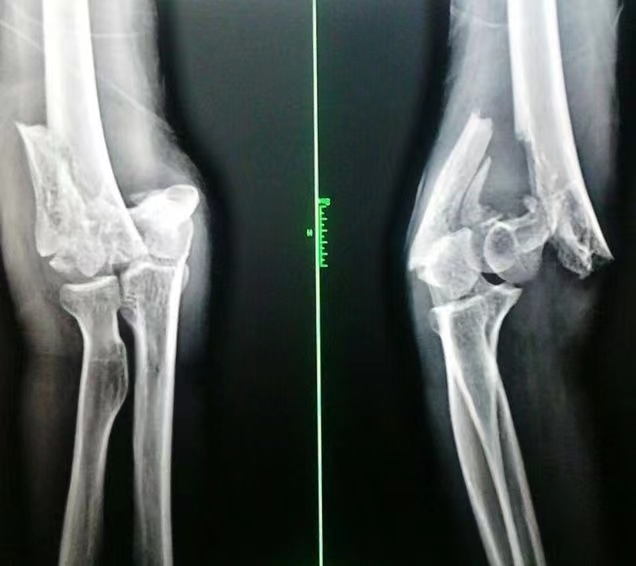 右肱骨髁上粉碎性骨折案例