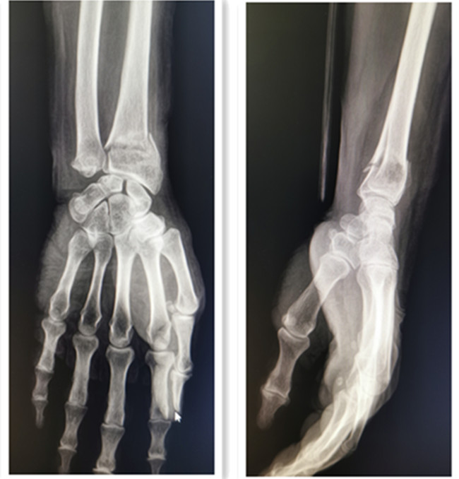 左桡骨远端骨折案例